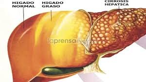Etapas de daño Hepático.
