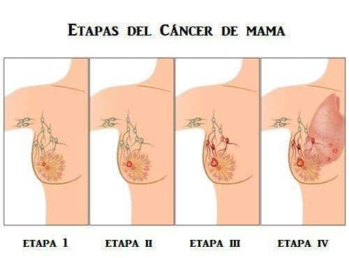 Cancer De Mama Y Los Beneficios De Los Productos Omnilife