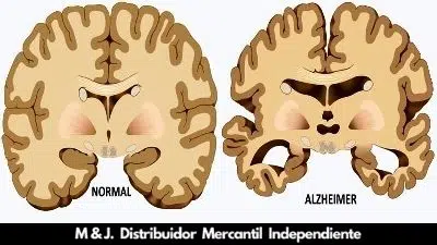 ALZHEIMER: ¿Podemos mejorar con una Nutrición especializada?