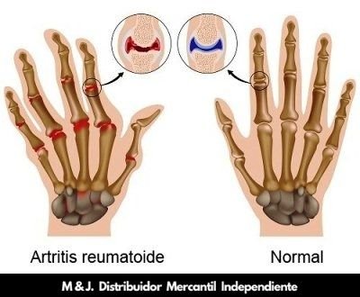 artritis reumatoides tratala con undú de omnilife