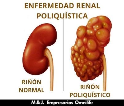 ego plan para riñones poliquísticos